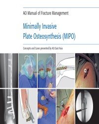 G. Tong - Minimally Invasive Plate Osteosynthesis (MIPO)