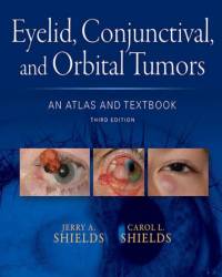 Jerry A. Shields - Eyelid, Conjunctival, and Orbital Tumors