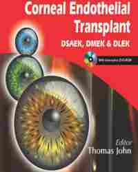Thomas John - Corneal Endothelial Transplant