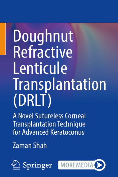 Doughnut refractive lenticule transplantation (drlt)